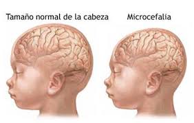 microcefalia 2
