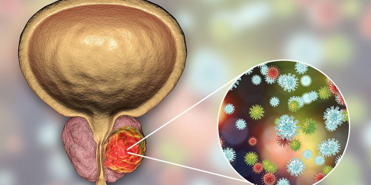 El revolucionario hallazgo que vincula el cáncer de próstata con bacterias en la orina