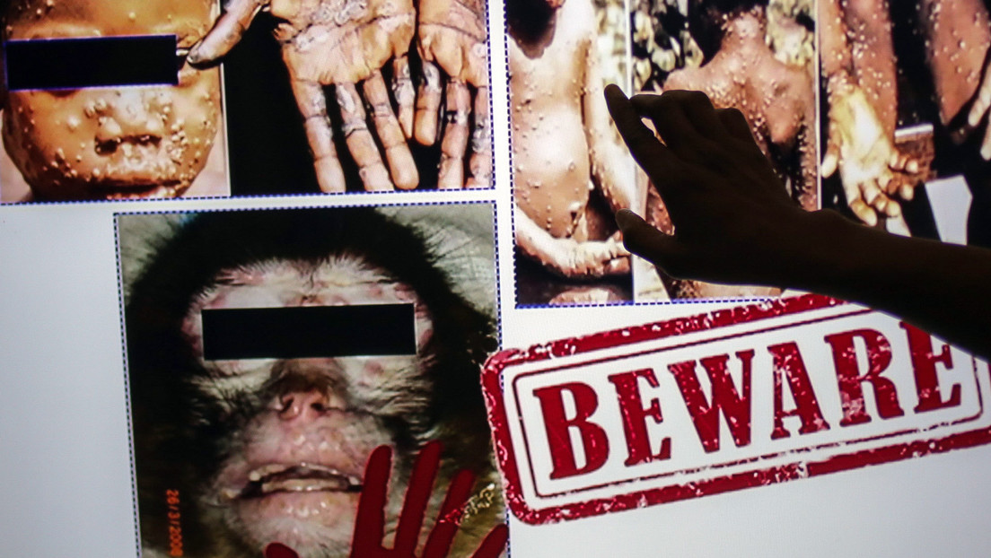 EE.UU. y Europa registran casos de la viruela del mono: ¿Qué se sabe de la enfermedad? ¿Cuán peligrosa es? ¿Hay tratamiento?