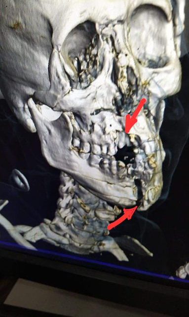 La impactante imagen de cómo quedó el cráneo del defensor de Arabia Saudita que chocó contra su arquero