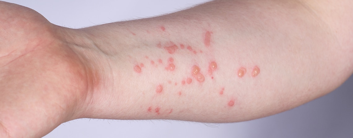 Viruela símica en Colombia supera los 4.200 casos registrados hasta agosto de 2024: estas son las ciudades más afectadas